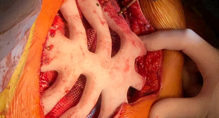 World First Ribcage Implant Becomes ‘Alive’