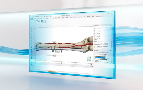 Personalize designs for your patient—Depending on your clinical application, planning can be as simple as taking measurements or as complex as performing a virtual surgery. The desktop-based Mimics Core and 3-matic software offer the flexibility and efficiency you need for this step.