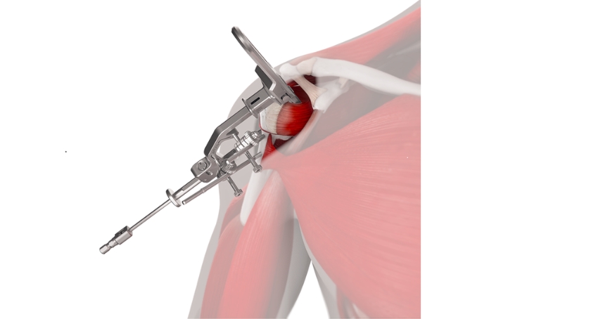 Johnson & Johnson MedTech Rolls Out Inhance Intact Shoulder Instruments